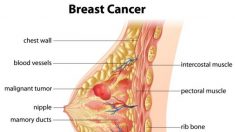 Ridurre il rischio di cancro con la dieta, i consigli degli esperti